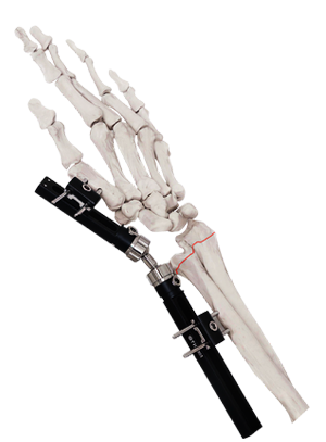 External Fixator System Manufacturer