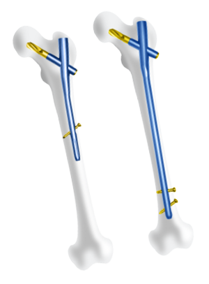 Orthopaedic Implants Manufacturer