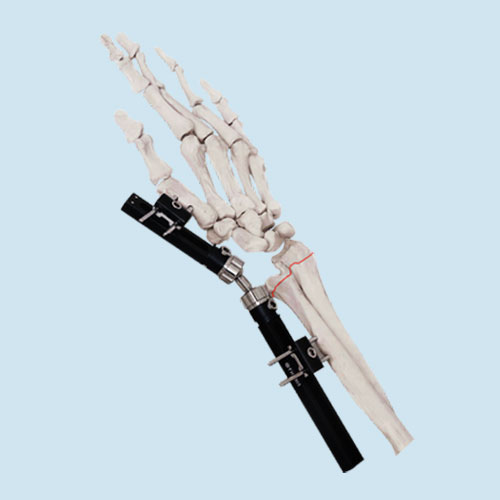 Orthopaedic External Fixators