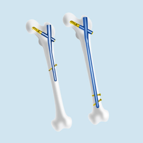 Orthopaedic Implants